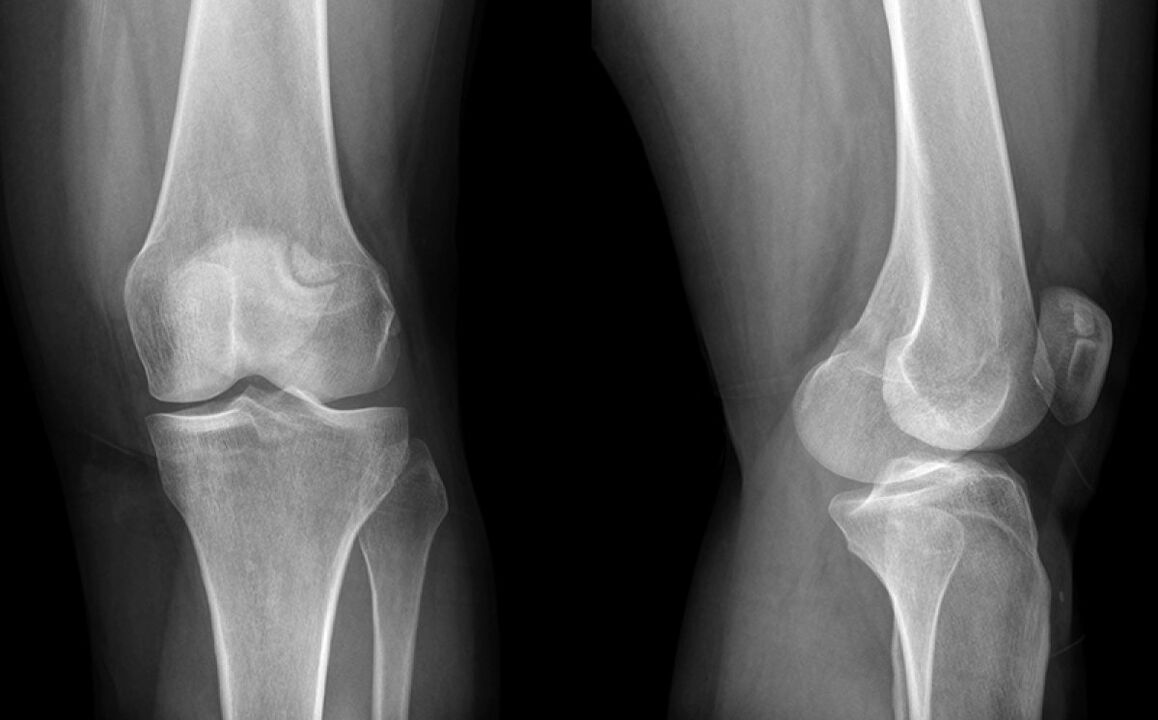 Põlve artroos x -ray -l enne Hondroine'i kasutamist