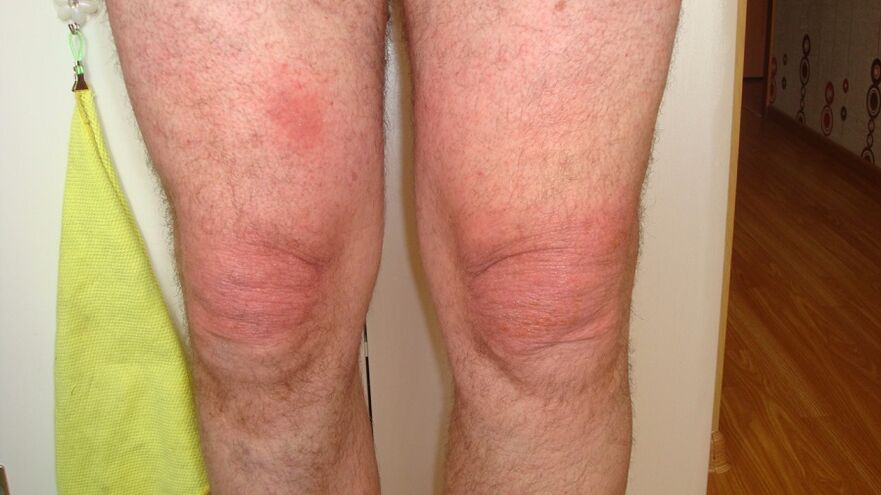 põlveliigeste artroos